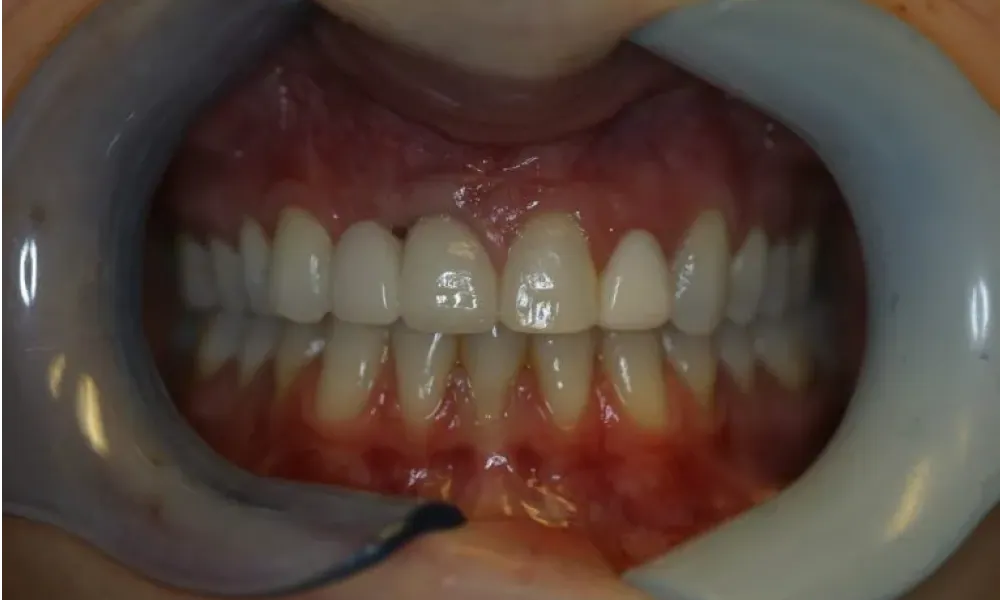 Clinical photo from Hope's smile reconstruction case